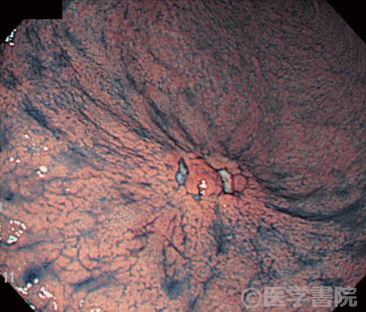 Fig. 1　早期胃癌（粘膜下層深部浸潤癌）0-IIa＋IIc 型のインジゴカルミン色素撒布像．空気により胃壁を強伸展すると，病変は台上に挙上し，周囲からひだ集中を伴っている．以上の表面構造は，色素の撒布により明瞭に観察され，深達度診断に有用な指標である．