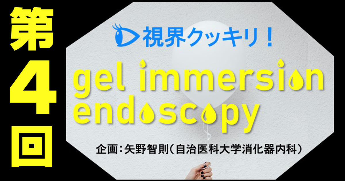 【第4回】gel immersion endoscopyを利用した食道EVL―EVL瘢痕だらけの食道でも使える！