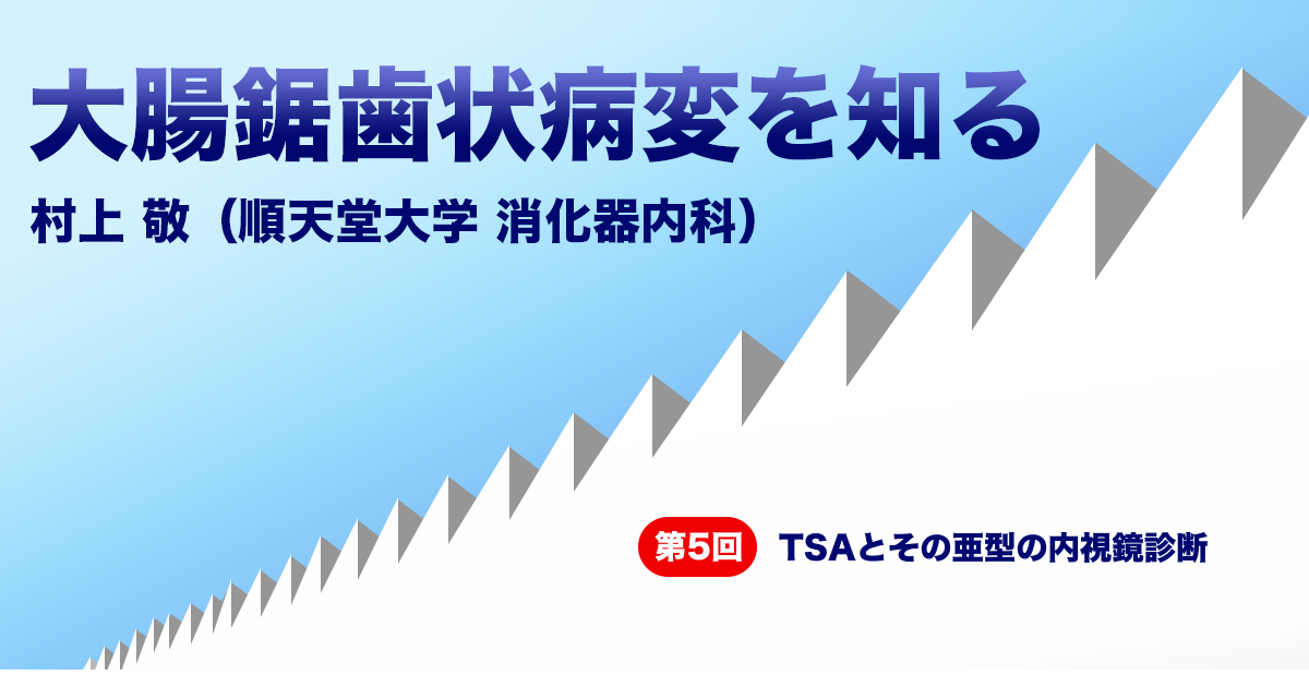 第5回 TSAとその亜型の内視鏡診断　<br>村上 敬（順天堂大学 消化器内科）