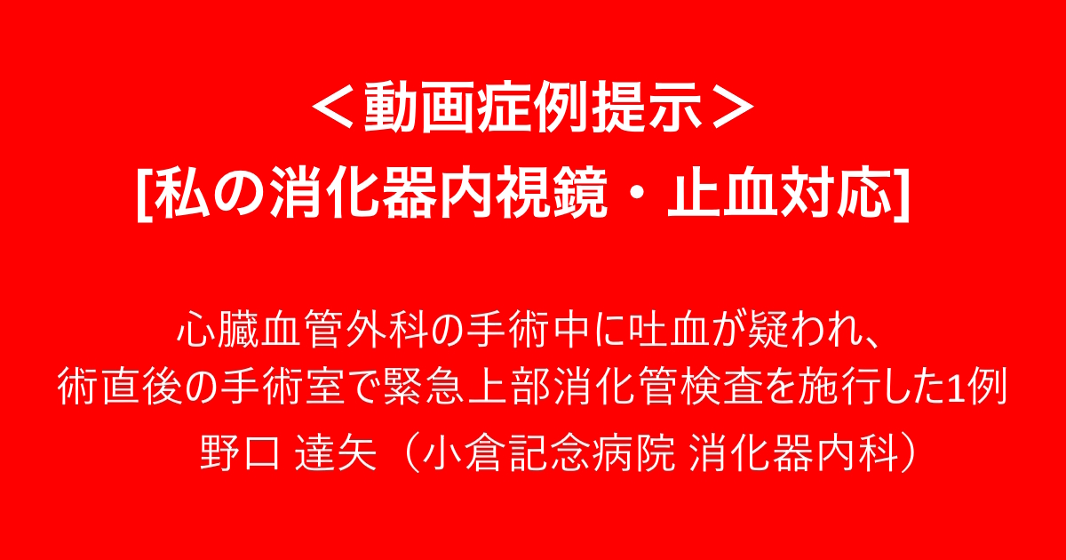 ＜動画症例提示＞ 　[私の消化器内視鏡・止血対応] 　心臓血管外科の手術中に吐血が疑われ、術直後の手術室で緊急上部消化管検査を施行した1例　野口 達矢（小倉記念病院 消化器内科）