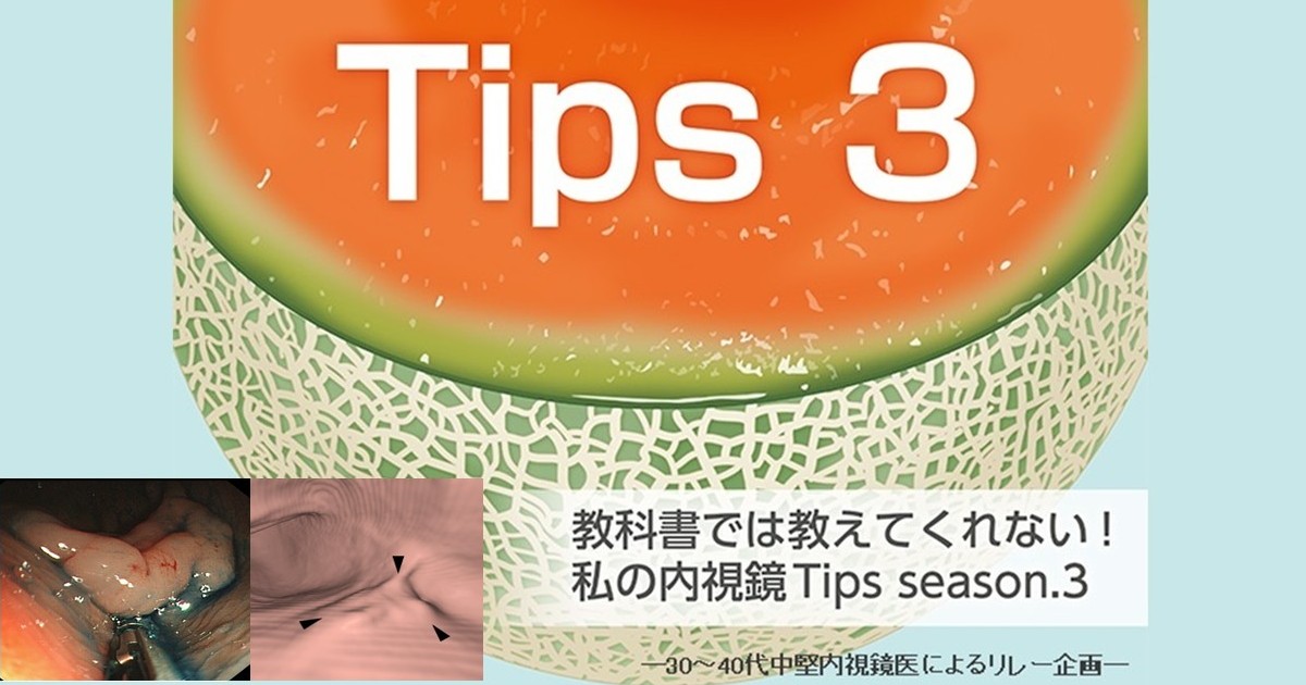 Tips296  CT colonographyで見る内視鏡の死角<br>鶴丸 大介（九州大学大学院医学研究院臨床放射線科学分野）