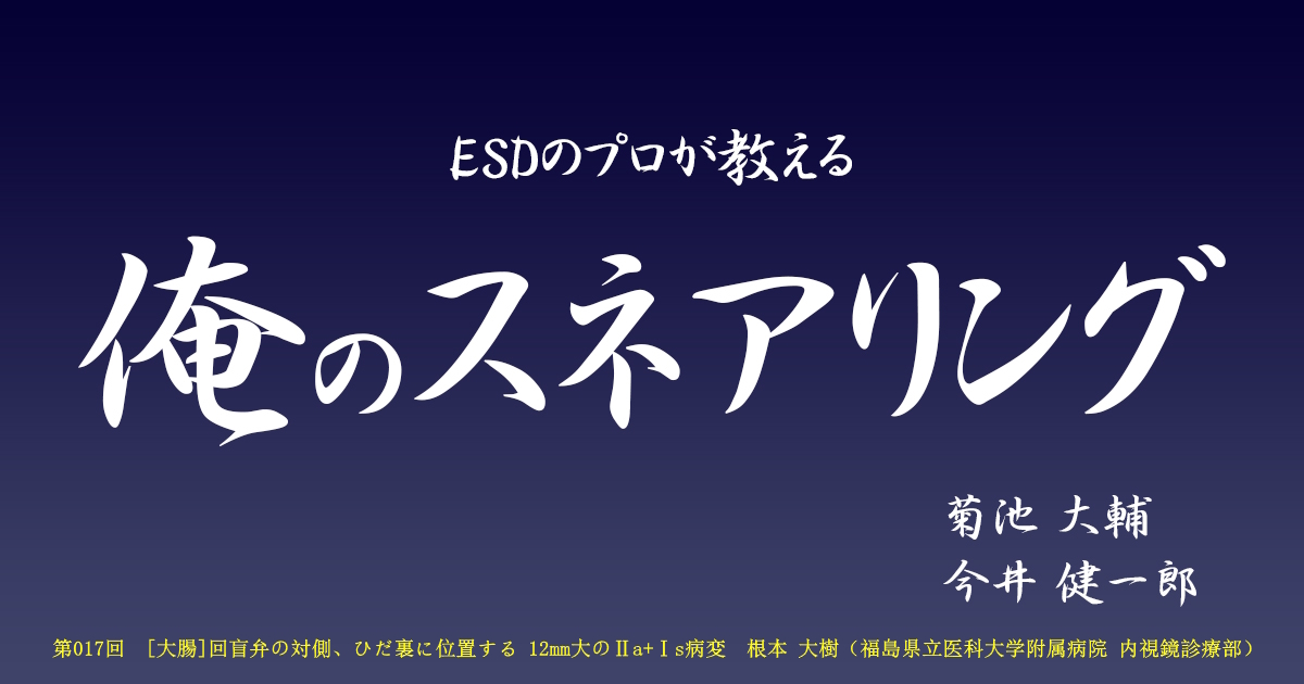第017回  [大腸] 回盲弁の対側、ひだ裏に位置する 12mm大のⅡa+Ⅰs病変　<br>根本 大樹（福島県立医科大学附属病院 内視鏡診療部）
