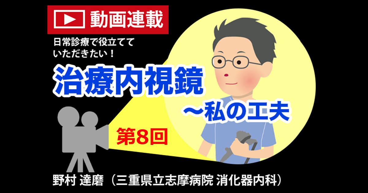 第8回　Tips of ROLM(Reopenable-clip over the line method)　<br>野村達磨（三重県立志摩病院 消化器内科）