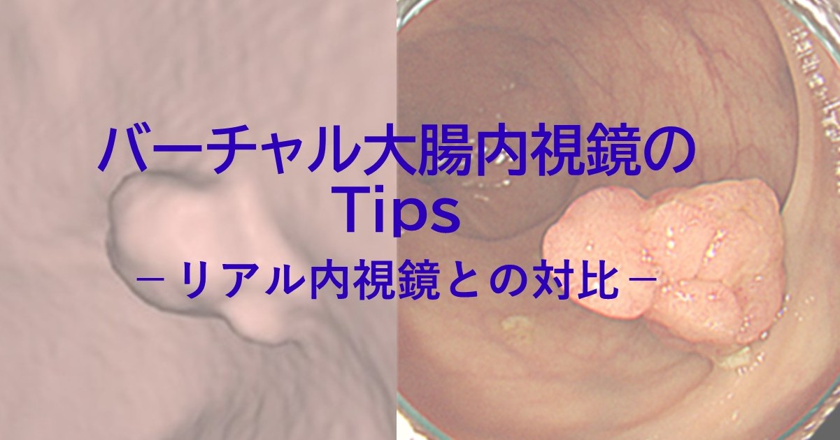 images/groups/1756199443_バーチャル大腸内視鏡のTips.jpg