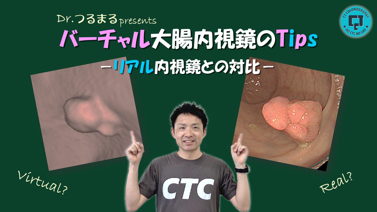 Dr.つるまるpresents バーチャル大腸内視鏡のTips－リアル内視鏡との対比