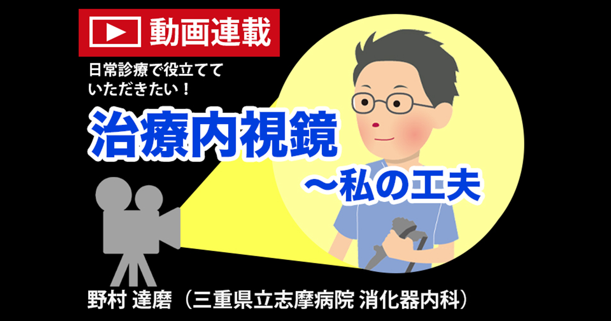 ＜動画連載＞日常診療で役立てていただきたい！治療内視鏡～私の工夫