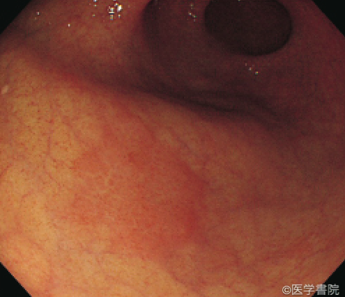 Fig. 1 a　胃体下部大彎前壁の0-IIa 型病変．