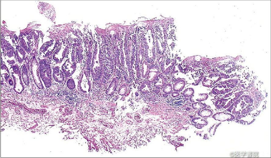 Fig. 1　pHM1 の症例．側方切除断端部に癌組織を認める．