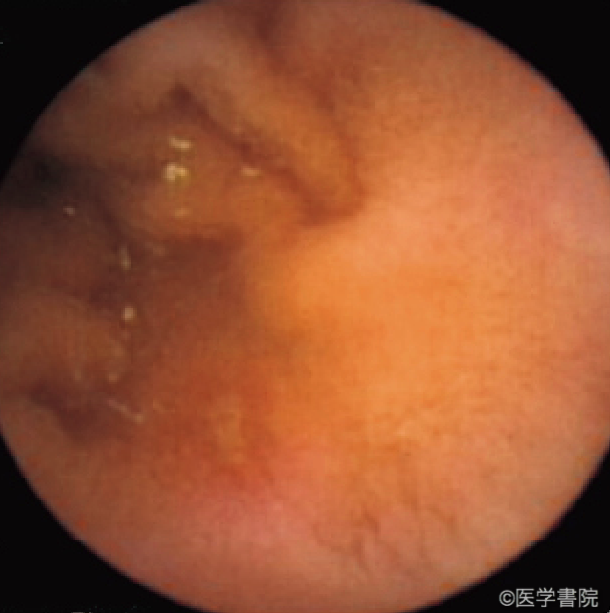 Fig. 1  b　潰瘍．周囲に発赤を伴う黄色の潰瘍底を認める．