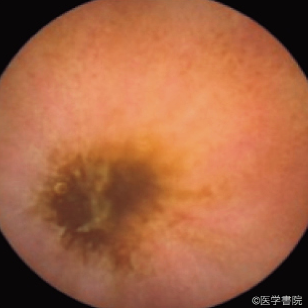 Fig. 1 a　絨毛浮腫．周囲に発赤を伴う黄色の潰瘍底を認める．