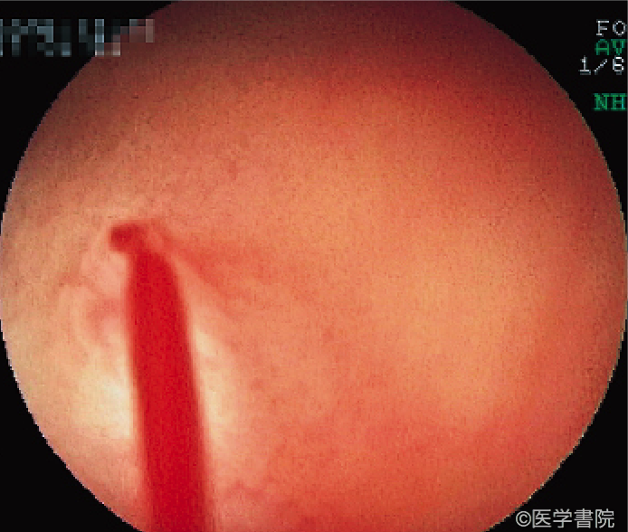 Fig. 2　Type 2a in the ileum with pulsatile bleeding in water.
〔矢野智則，他．小さな小腸血管性病変．胃と腸 44 : 944-950 , 2009 , Fig. 10 b より転載〕