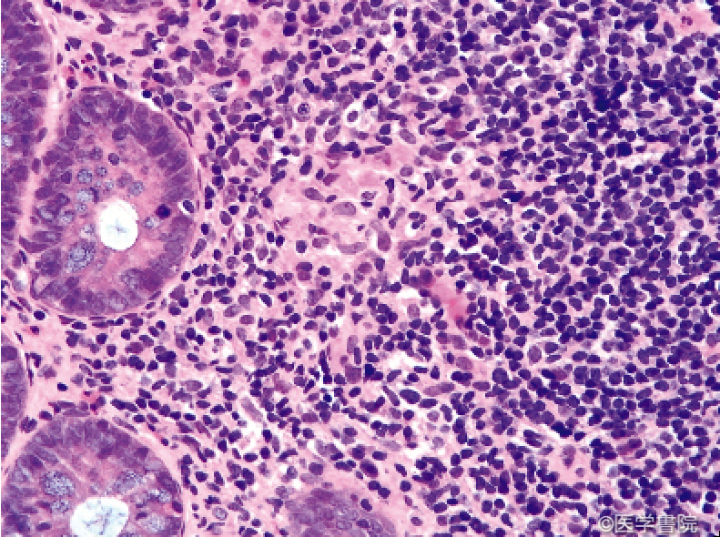 Fig. 1 a　Crohn 病の典型的な萎縮性類上皮細胞肉芽腫．