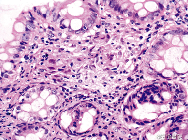 Fig. 1 b　抗結核剤治療後の結核にみられた萎縮性類上皮細胞肉芽腫．