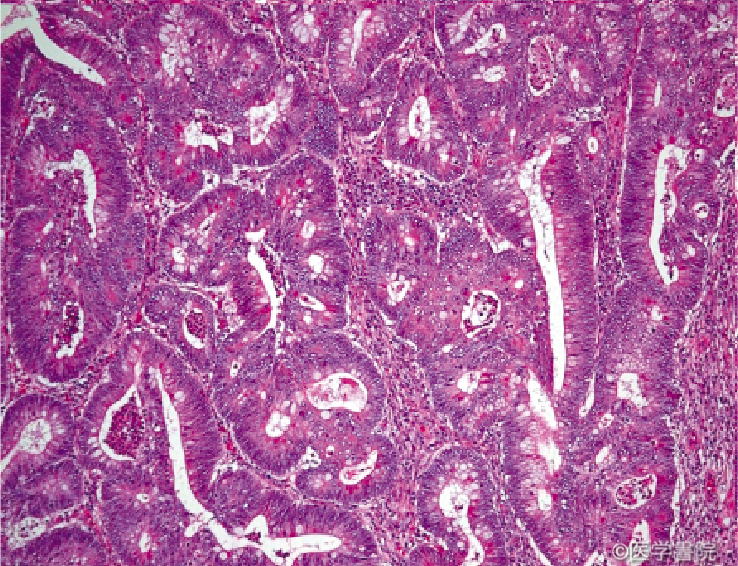 Fig. 1 b　 癌部（高分化～中分化管状腺癌）．