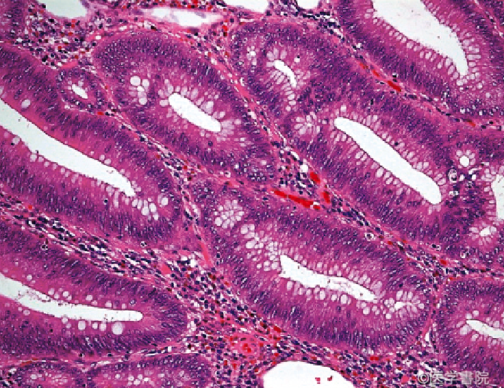 Fig. 1c　 癌部周囲の腺腫部（低異型度管状腺腫）．