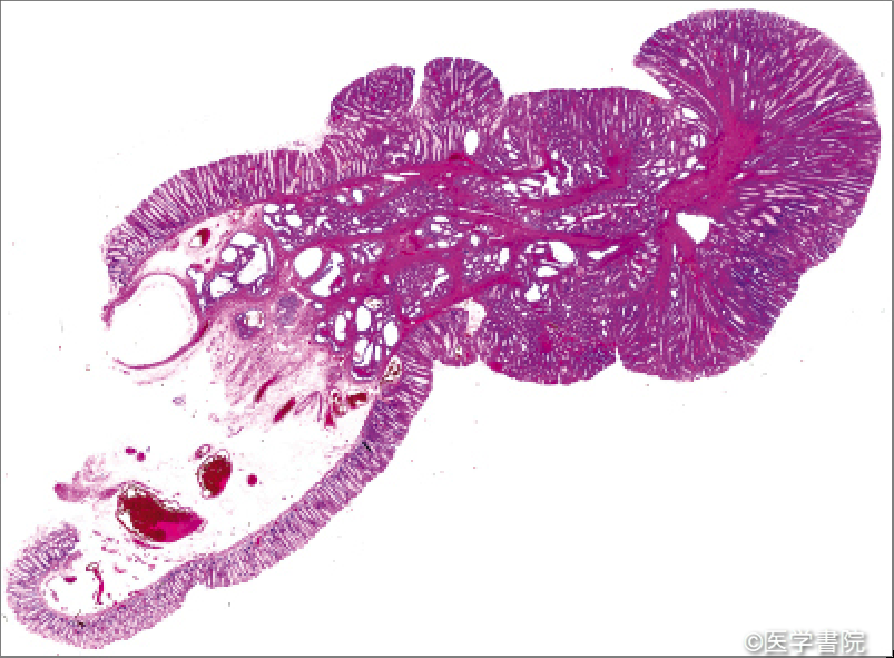 Fig. 1　偽浸潤を伴うS 状結腸の有茎性ポリープ．粘膜下層に腺腫腺管が逸脱している．