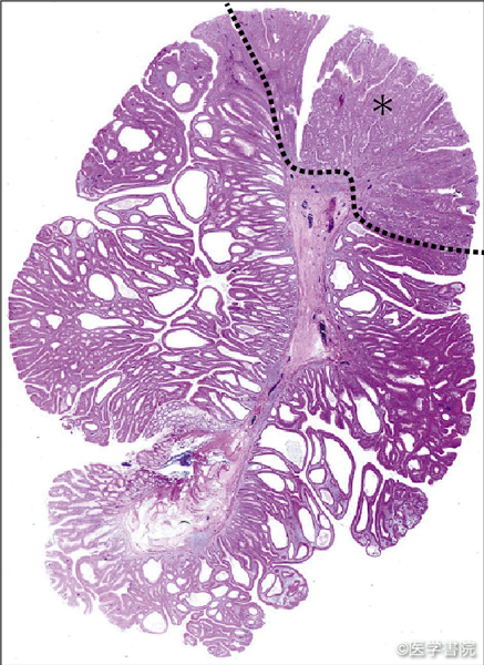 Fig. 1a　大きさ10 mm の0-Ip 型pM 癌（腺腫内癌，＊部分が癌部）．