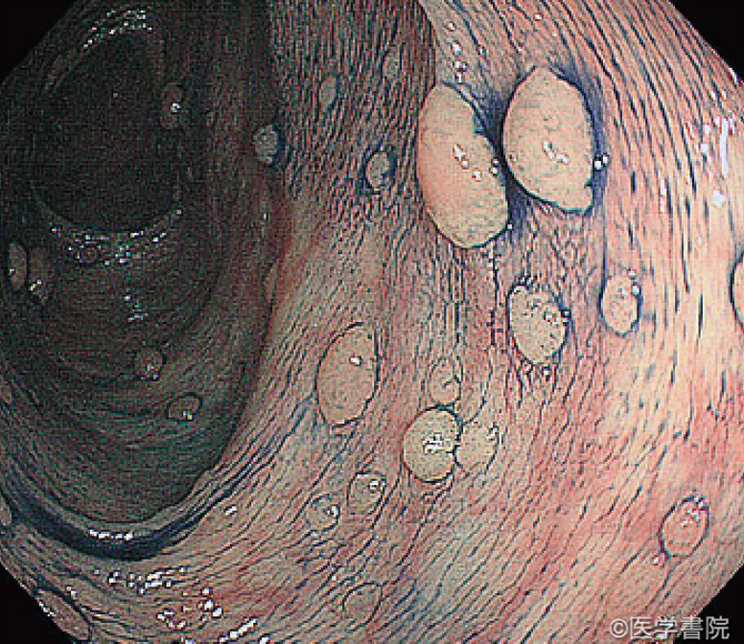 Fig. 1　大腸腺腫症の内視鏡像．大小様々な無茎性隆起が多発している．