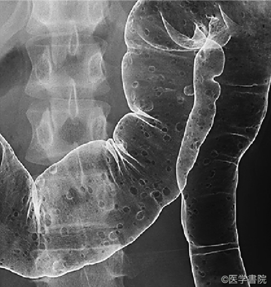 Fig. 2　大腸腺腫症のX 線像．大腸に多発する透亮像を認める．