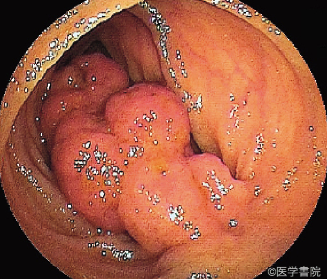 Fig. 2　Peutz-Jeghers 症候群における小腸ポリープの内視鏡像．