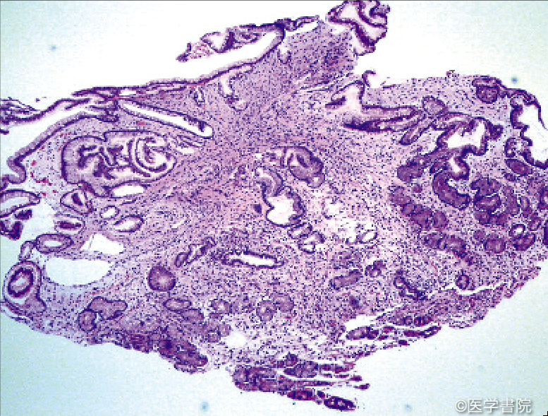 Fig. 1　ポリープからの生検．強い浮腫状間質と囊胞状拡張腺管の増生を認める．