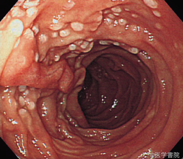 Fig. 1a　消化管原発濾胞性リンパ腫の十二指腸病変．十二指腸下行部に白色顆粒状隆起の集簇を認める．
