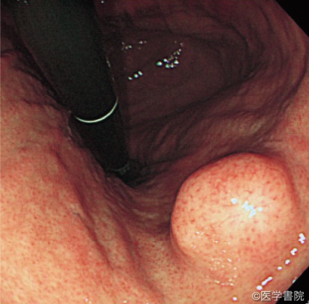 Fig. 1　胃GIST．　　　　　　　　　　　　　　　　　　　　　　　　　　a　 胃のGIST で表面波平滑な粘膜下腫瘍である．
