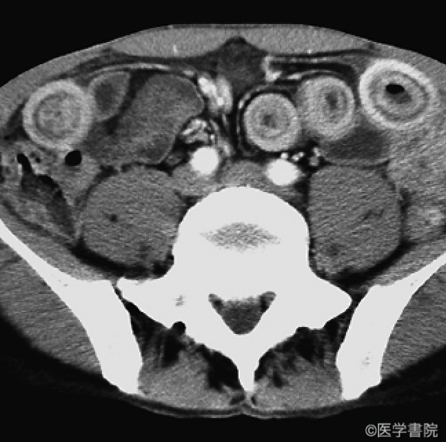c　 造影CT では小腸壁が壁構造を保ったまま高度に肥厚し，固有筋層の造影効果が顕著である．