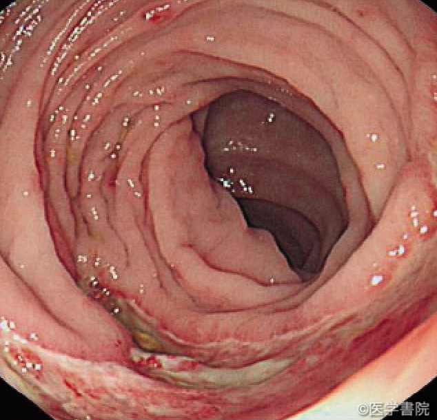 Fig. 1b　 Churg-Strauss 症候群．盲腸からS 状結腸にかけて辺縁に発赤を伴う浅い地図状潰瘍が多発していた．