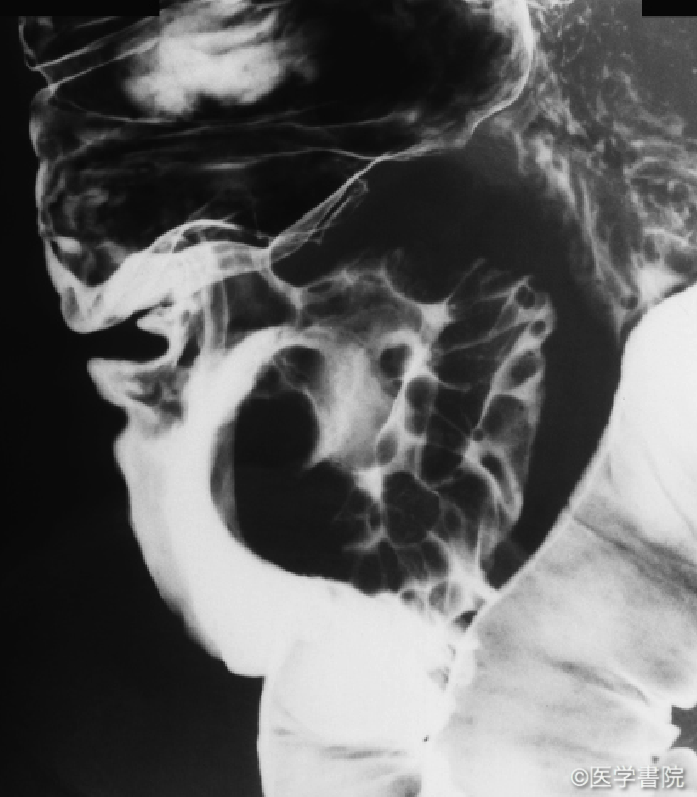 Fig. 1　定型的病変のX 線像．回盲弁に境界鮮鋭で明瞭なバリウム斑を認める．辺縁には先端の腫大したひだ集中像を認める．