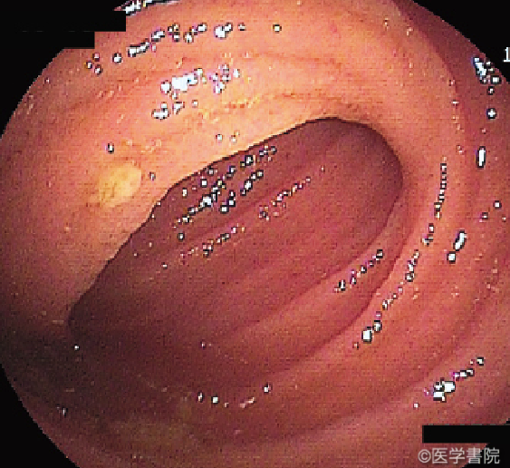 Fig. 2　非定型的病変のダブルバルーン小腸内視鏡所見．定型的病変から離れた回腸に認められた境界明瞭な打ち抜き様の小潰瘍．