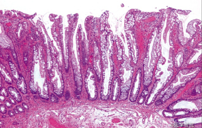 Fig. 1a　大腸鋸歯状病変の病理組織像．hyperplastic polyp（弱拡大）．　