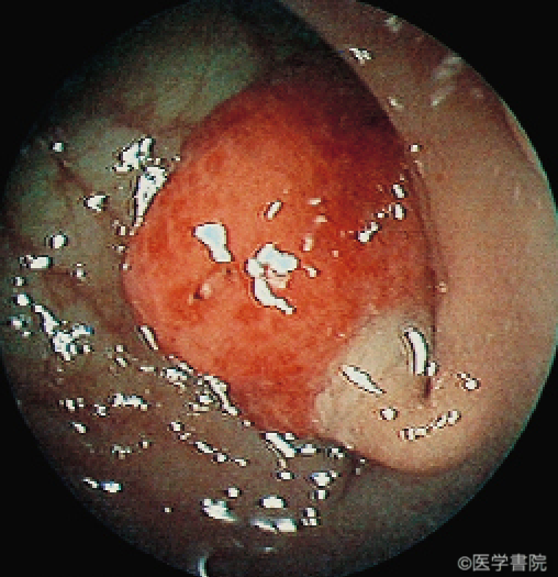 Fig. 1a　内視鏡で観察された炎症性筋腺管ポリープ．長い茎をもった球形のポリープがみられる． ポリープ表面はのっぺりとし発赤が強く，傷んだイチゴのようである．　　　　　　　　　　　　　　　　　　　　　　　　　　　　　　　　　　　　　　　　　