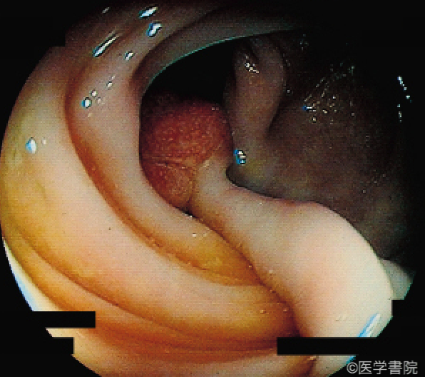 Fig. 1c　内視鏡で観察された炎症性筋腺管ポリープ．長い茎をもった球形のポリープがみられる． ポリープ表面はのっぺりとし発赤が強く，傷んだイチゴのようである．　　　　
