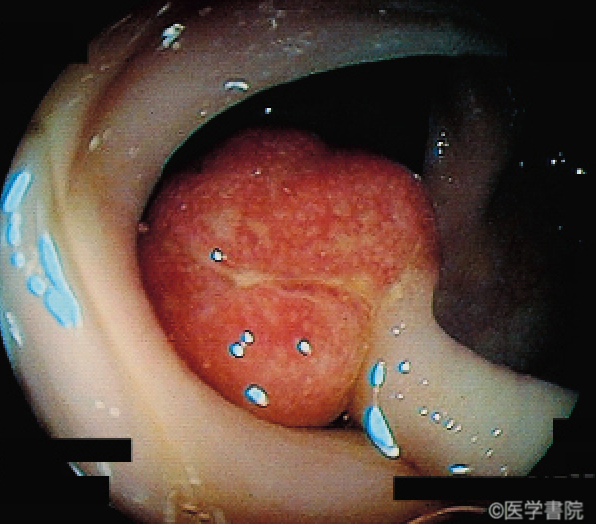 Fig. d　内視鏡で観察された炎症性筋腺管ポリープ．長い茎をもった球形のポリープがみられる． ポリープ表面はのっぺりとし発赤が強く，傷んだイチゴのようである．　　　　