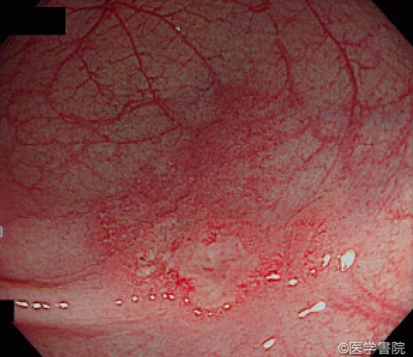 Fig. 1a〔症例1〕　内視鏡画像．横行結腸に15 mm 大の境界がやや不明瞭な不整形の発赤とびらんを認めた．
