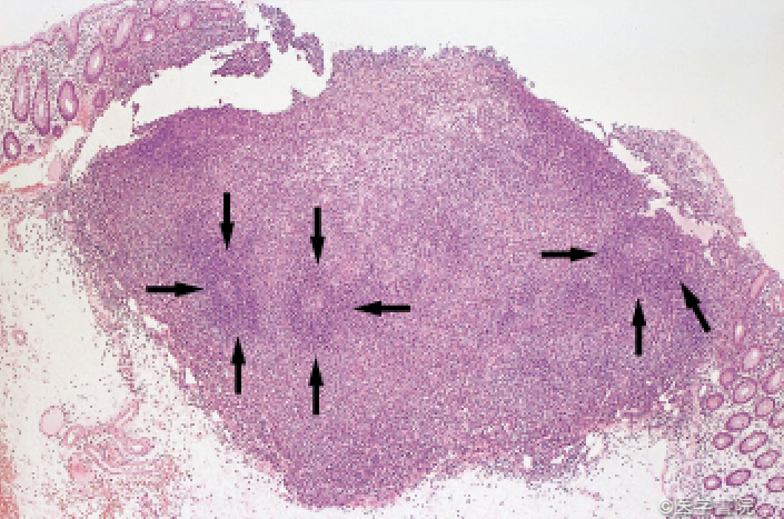 Fig. 1　直腸S 状部原発MALT リンパ腫の病理像．
a　 全割面切片のルーペ像．病巣は粘膜下層に存在し，マントル層（矢印）の外縁に相当する濾胞辺縁帯が細胞増殖の場である．
