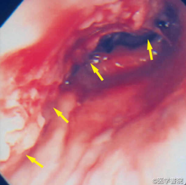 Fig. 1a　肛門管扁平上皮癌．大腸内視鏡像．肛門管前壁中心に半周性を占める隆起性病変（矢印）．