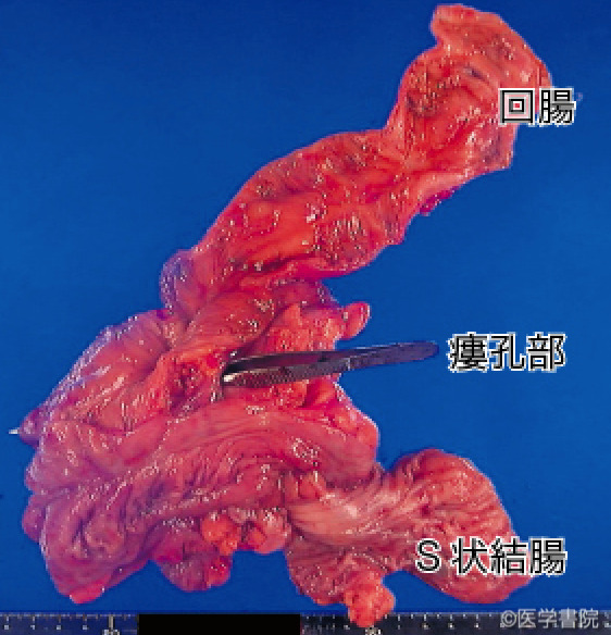 Fig. 1b　〔症例1〕　回腸～ S 状結腸瘻部に発症した瘻孔癌．回腸には縦走潰瘍が認められるが，発癌を疑う所見はない．瘻孔部にセッシを挿入している．