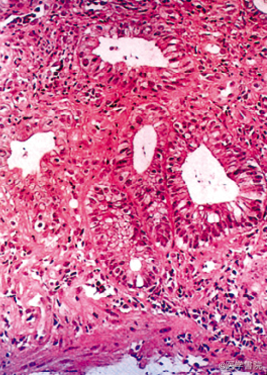 Fig. 1e　潰瘍型MPS． 病理組織所見．生検で粘膜固有層内に平滑筋の増生を伴う線維筋症（fibromuscular obliteration）の所見を認める．