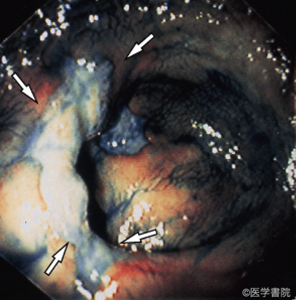 Fig. 1c 潰瘍型MPS．大腸内視鏡検査所見．下部直腸に不整形の潰瘍を認める（矢印）．