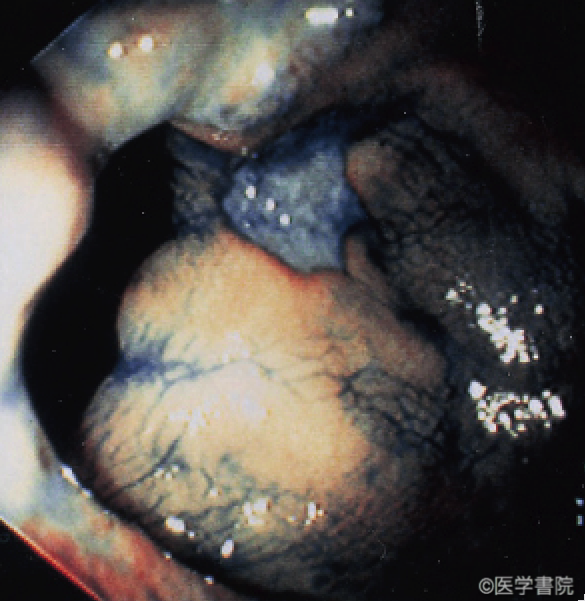 Fig. 1d　 潰瘍型MPS．大腸内視鏡検査所見．潰瘍は多発している．