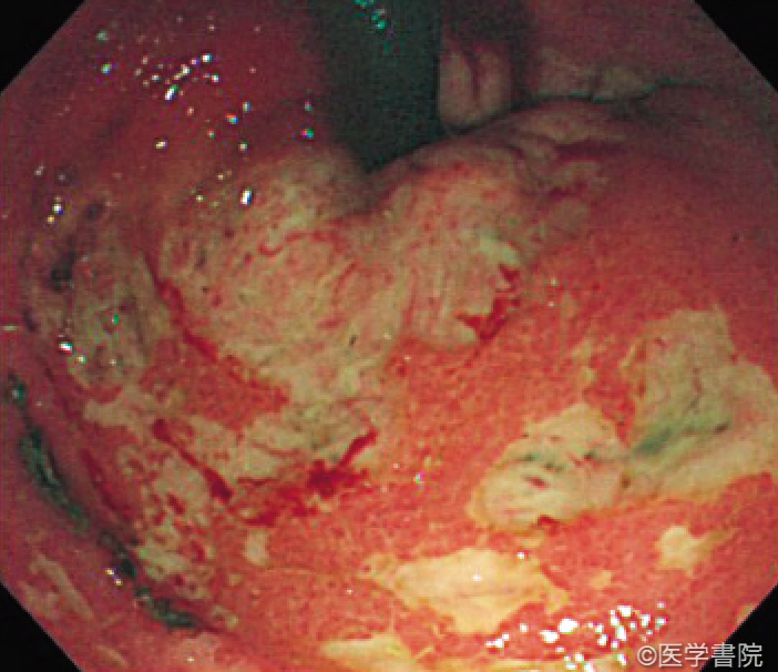 Fig. 1b　 急性出血性直腸潰瘍症例，肛門出血当日の内視鏡像．反転観察．輪状潰瘍は歯状線近傍にみられる．また類円形，地図状の浅い潰瘍が多発している．