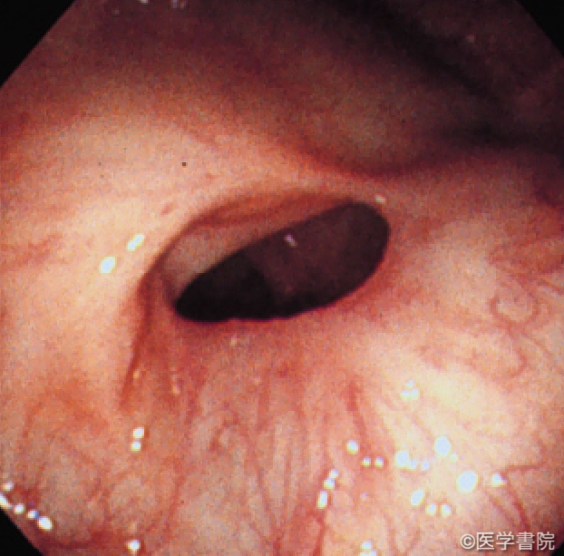 Fig. 1　NSAID 起因性大腸病変の大腸内視鏡像．回盲部の膜様狭窄（潰瘍治癒期）．