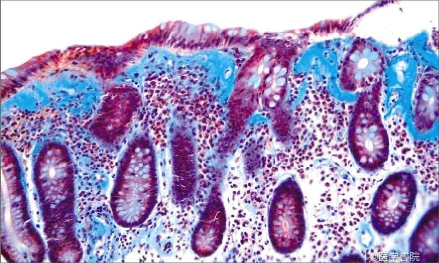 Fig. 1　collagenous colitis．被蓋上皮直下の膠原線維束（S状結腸）．