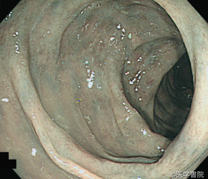 Fig. 1　特発性腸間膜静脈硬化症の大腸内視鏡像．