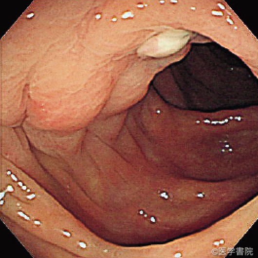 Fig. 1　大腸憩室炎の内視鏡像（膿付着と浮腫）．