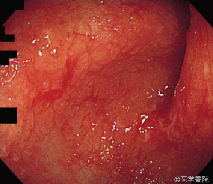 Fig. 1a  　GVHD 関連腸炎の大腸内視鏡像． S 状結腸に粘膜の血管透見低下，発赤，浮腫，びらん，易出血性所見を認める．

