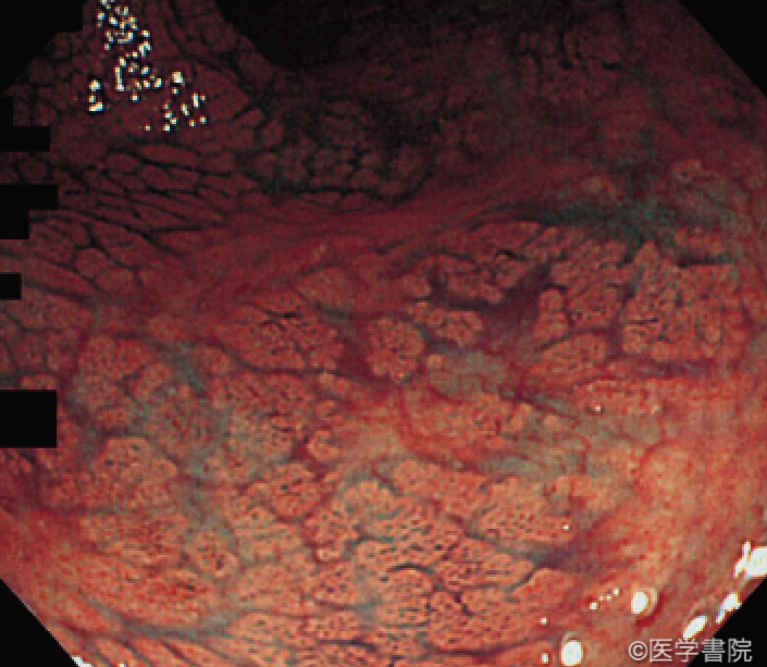 Fig. 1b　GVHD 関連腸炎の大腸内視鏡像．インジコカルミン撒布で“orange peel”所見が明瞭となる．