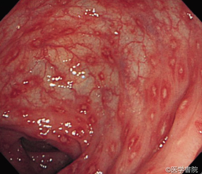Fig. 1　非偽膜性C. difficile腸炎．多発する斑状の発赤やアフタ様病変をS 状結腸～直腸に認める．